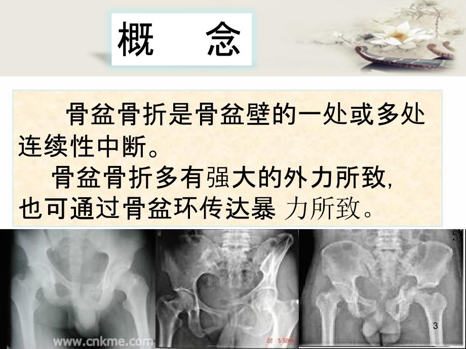 骨盆骨折护理PPT教学课件_第3页