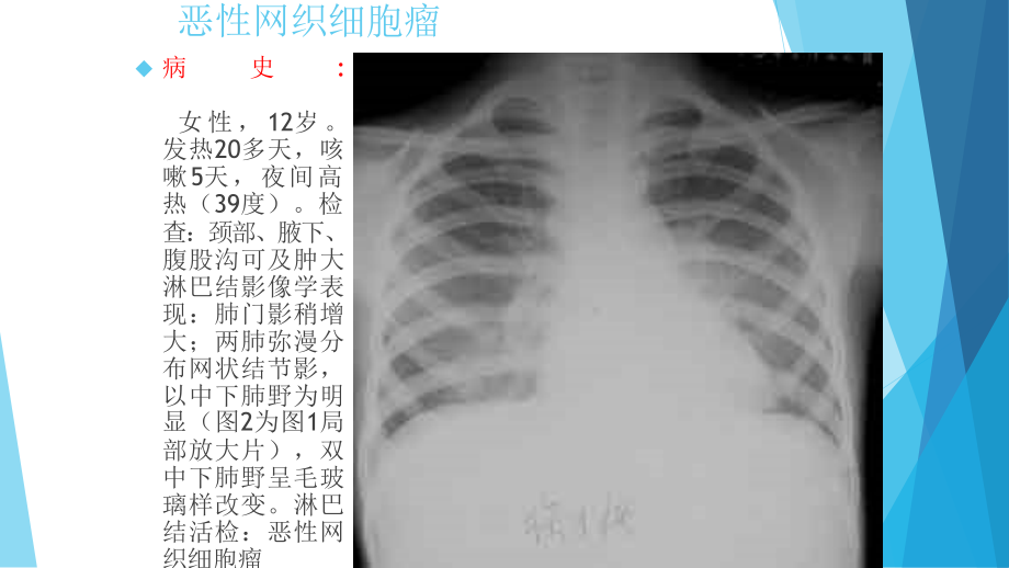 肺癌诊断1肺癌诊断课件PPT_第4页