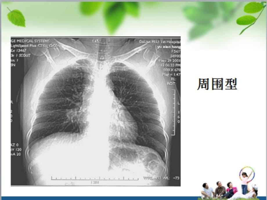 肺癌查房课件PPT_第5页