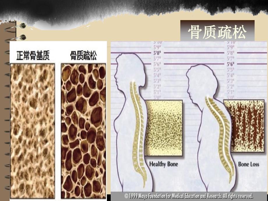 骨质疏松的护理课件PPT_第3页