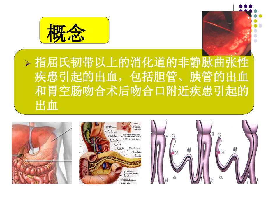 急性非静脉曲张性上消化道出血诊治指南(2009杭州)课件PPT_第2页