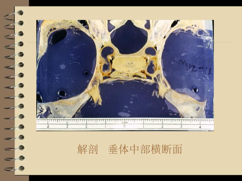 海绵窦病变影像学诊断课件PPT_第4页