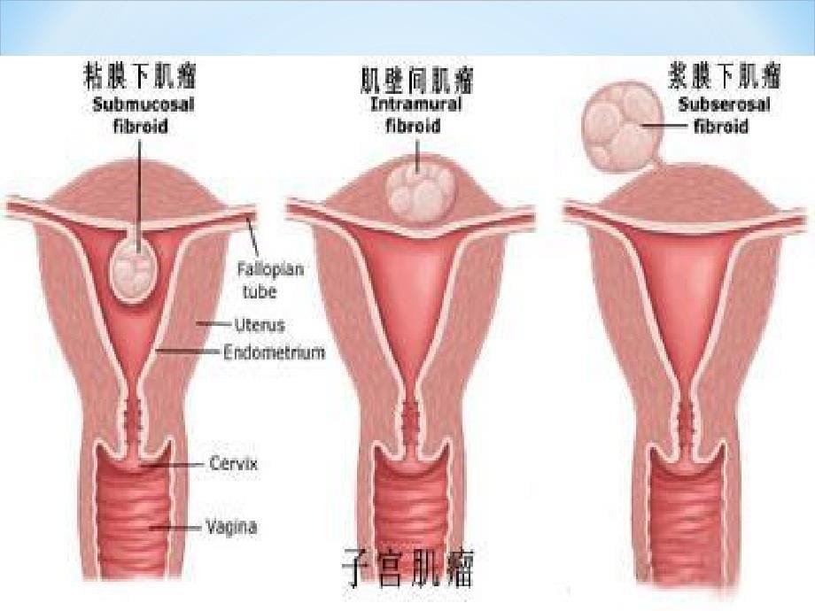 子宫肌瘤宣教1课件PPT_第5页