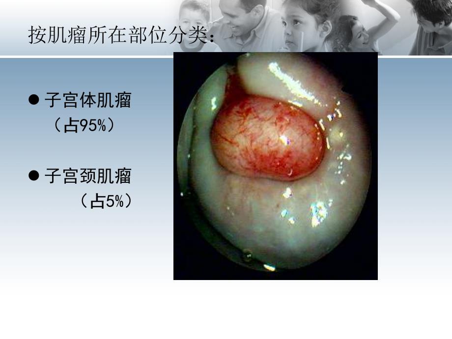 子宫肌瘤杨岚课件PPT_第4页