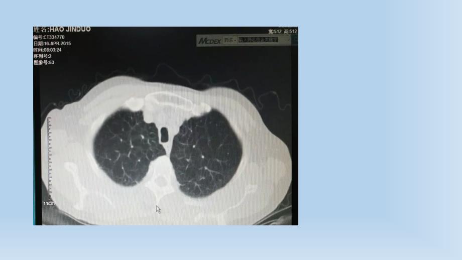 慢性阻塞性肺肺病课件PPT_第4页