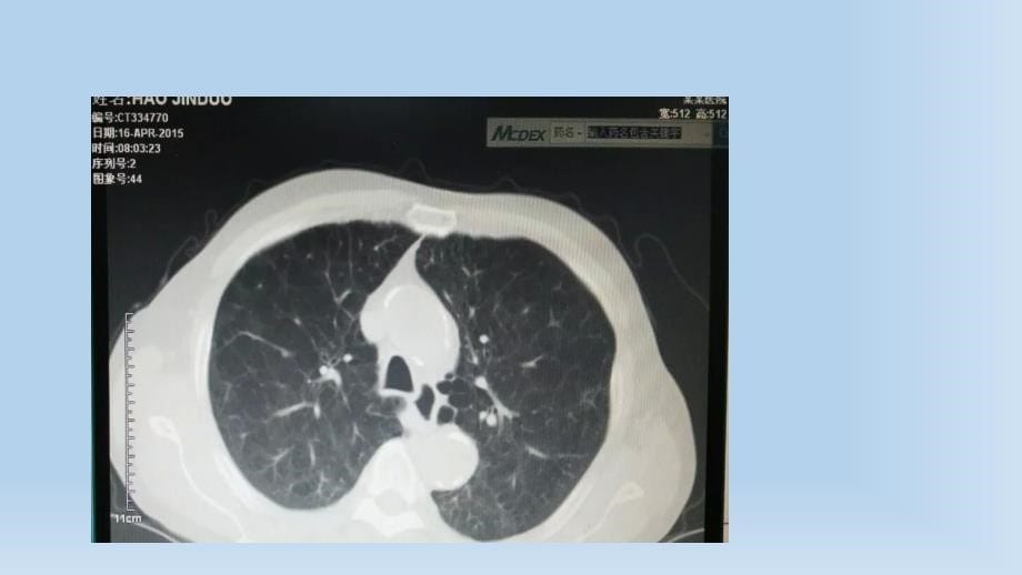 慢性阻塞性肺肺病课件PPT_第5页