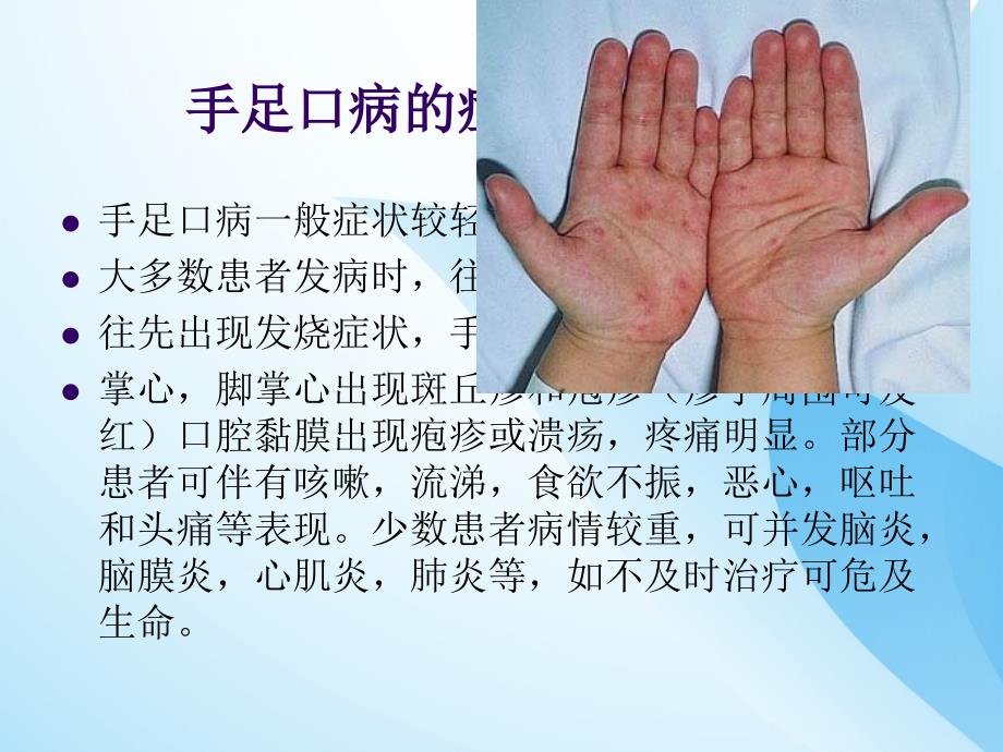 手足口病预防知识及中医保健课件PPT_第3页