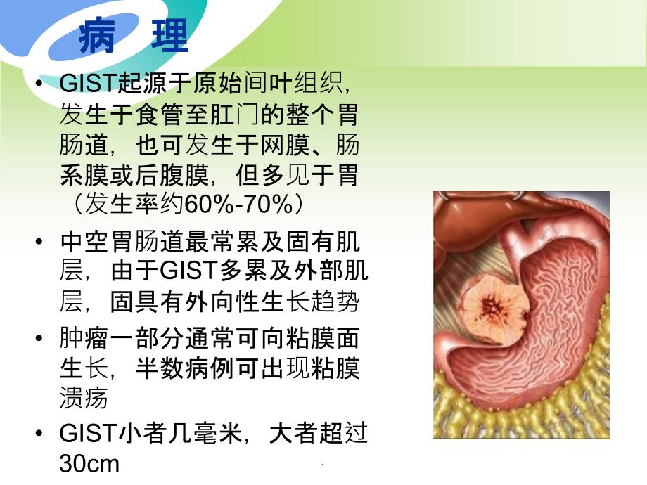 胃肠道间质瘤CT诊断与鉴别诊断ppt课件_第4页