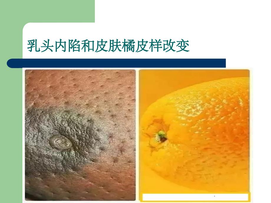 乳腺癌诊疗流程ppt课件_第3页