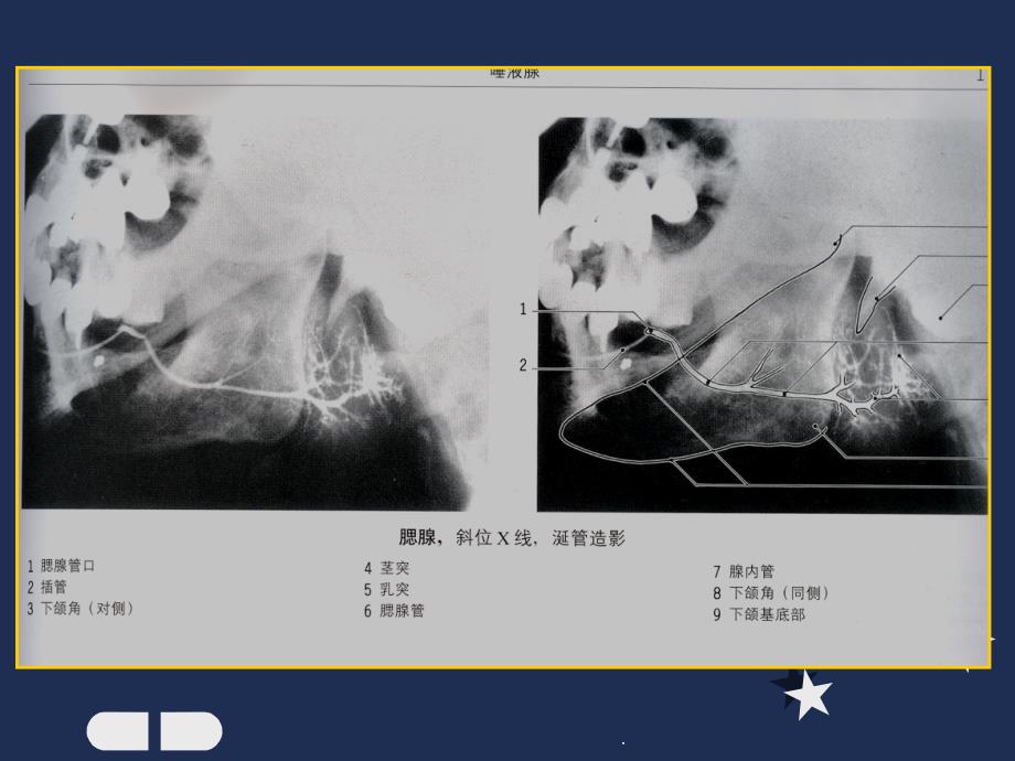 腮腺疾病的影像诊断ppt课件_第3页