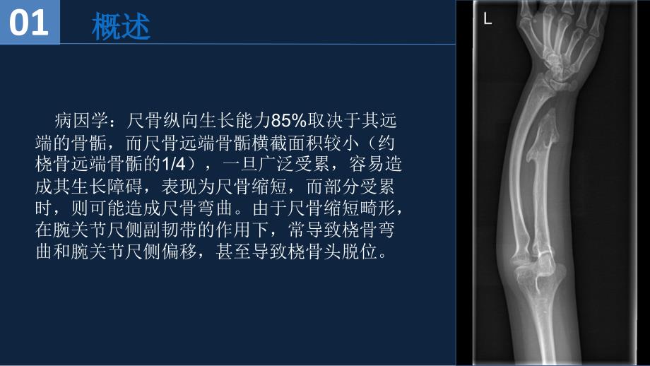 尺骨远端遗传性多发性骨软骨瘤病课件PPT_第4页