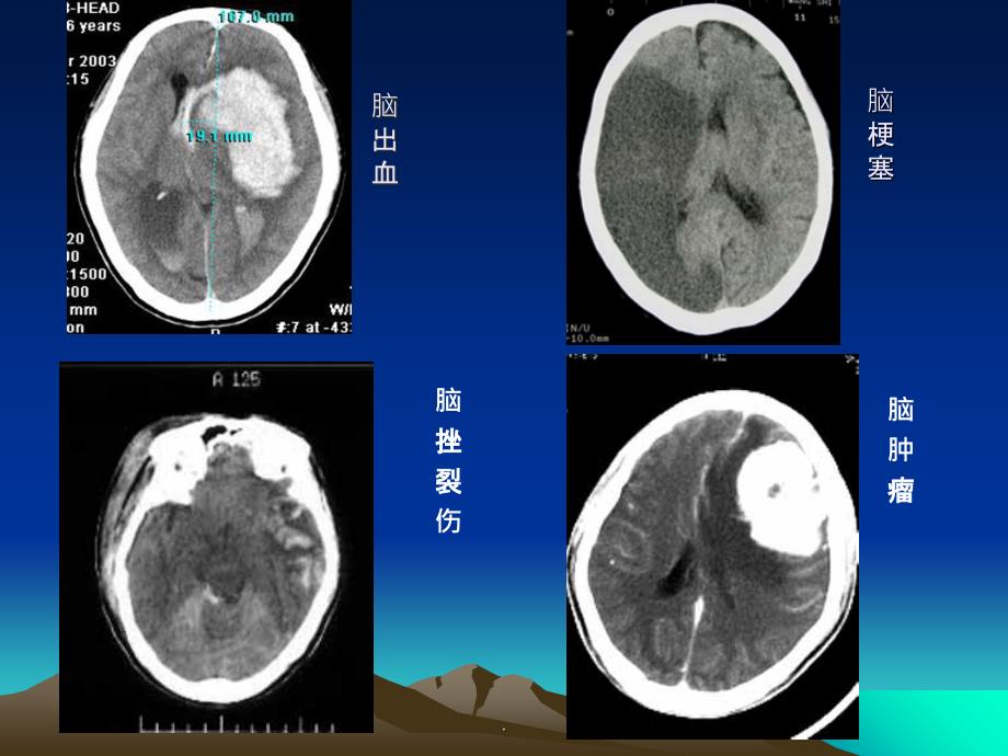 神经外科CT影像基础ppt课件_第3页