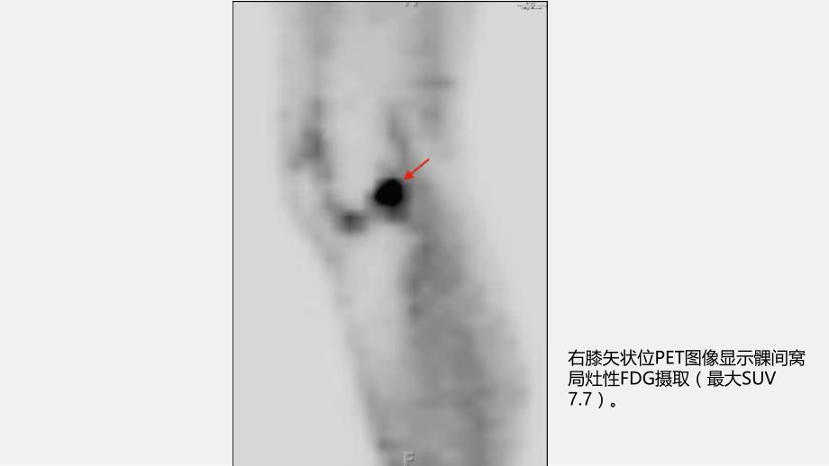 E之膝关节骨性关节炎影像学病例课件PPT_第3页