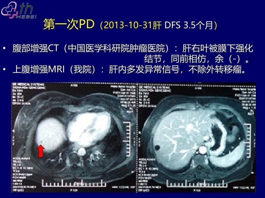 乳腺癌典型病例讨论一例课件PPT_第5页