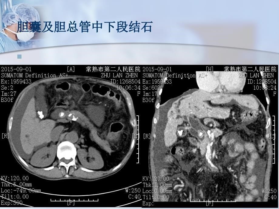 梗阻性黄疸课件PPT_第5页