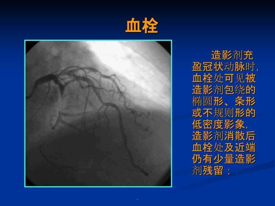 ACS危险分层ppt课件_第5页