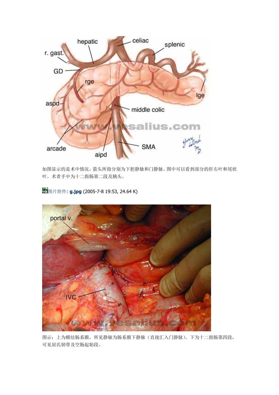 胰十二指肠切除术手术记录.doc_第4页