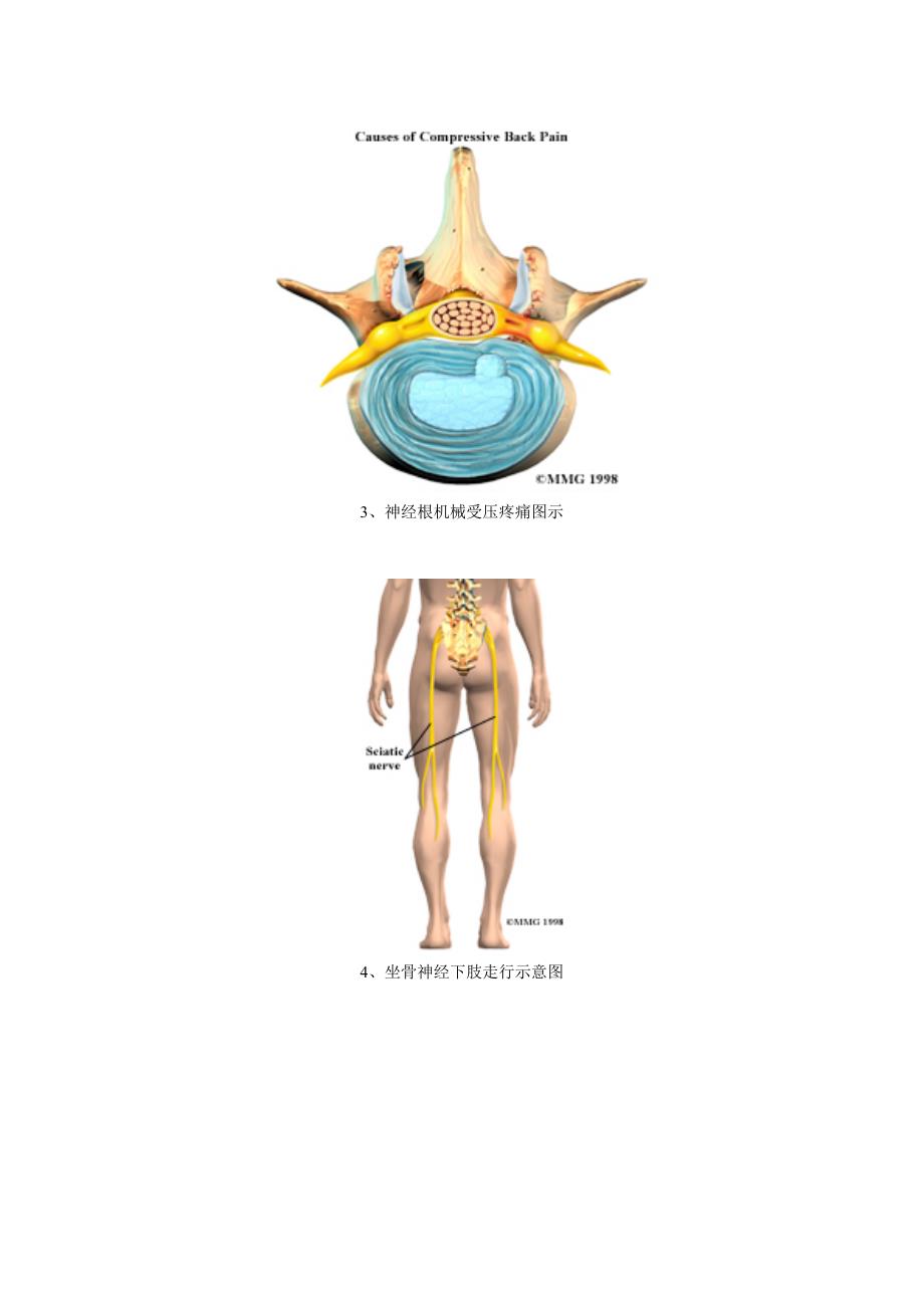 腰椎病、腰间盘突出解剖图.doc_第2页