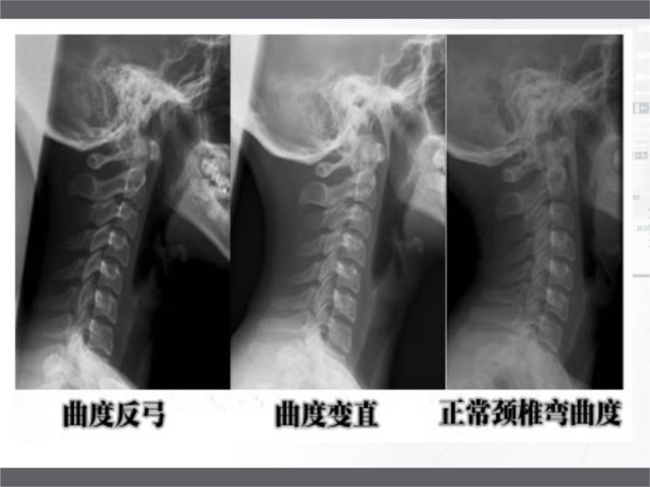 枕颌带牵引的护理说课讲解_第3页