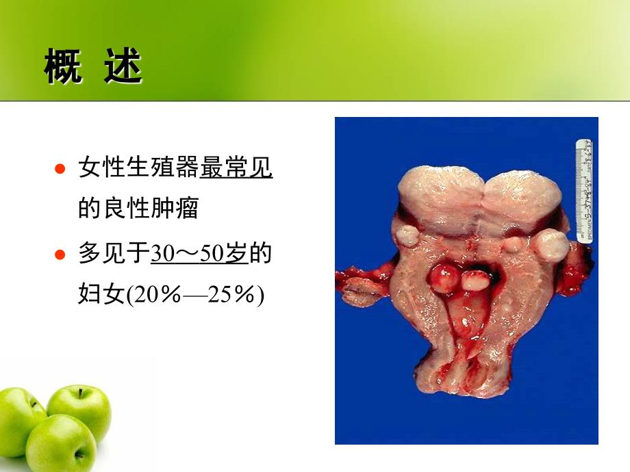 子宫肌瘤-讲课复习课程_第2页