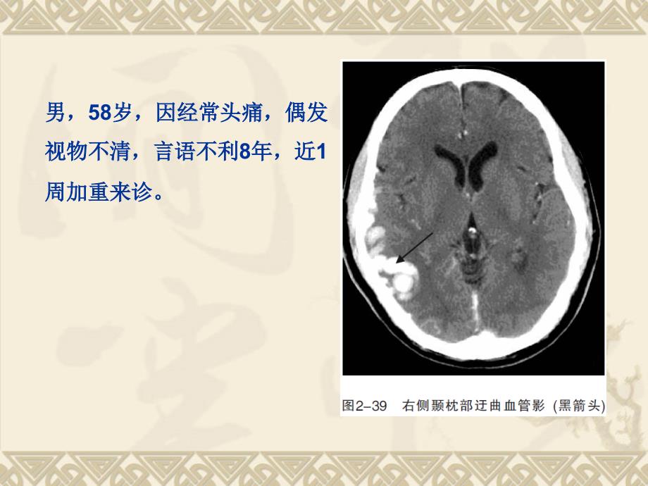 脑血管疾病(脑血管畸形) ct.ppt_第4页