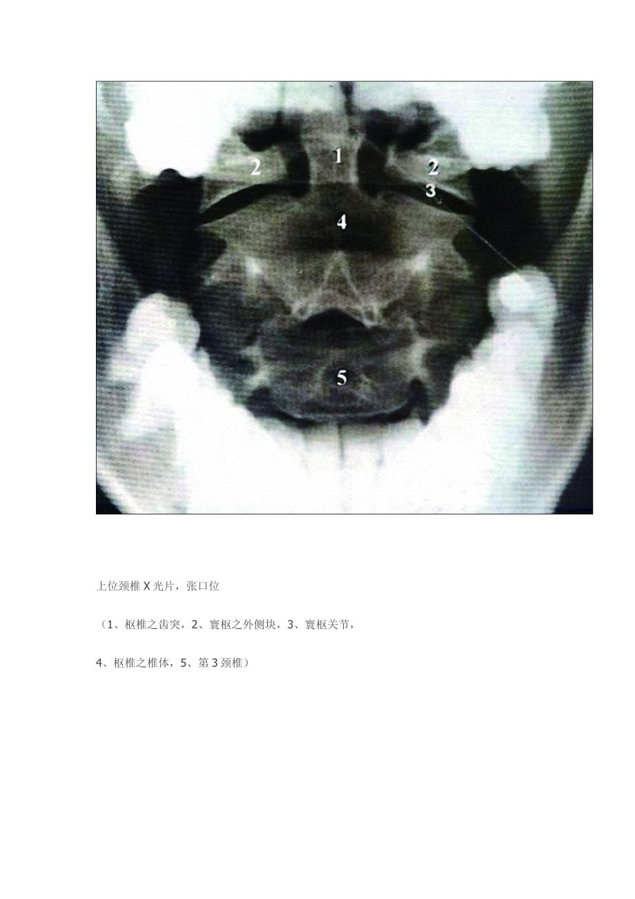 全脊柱影像学诊断.doc_第3页