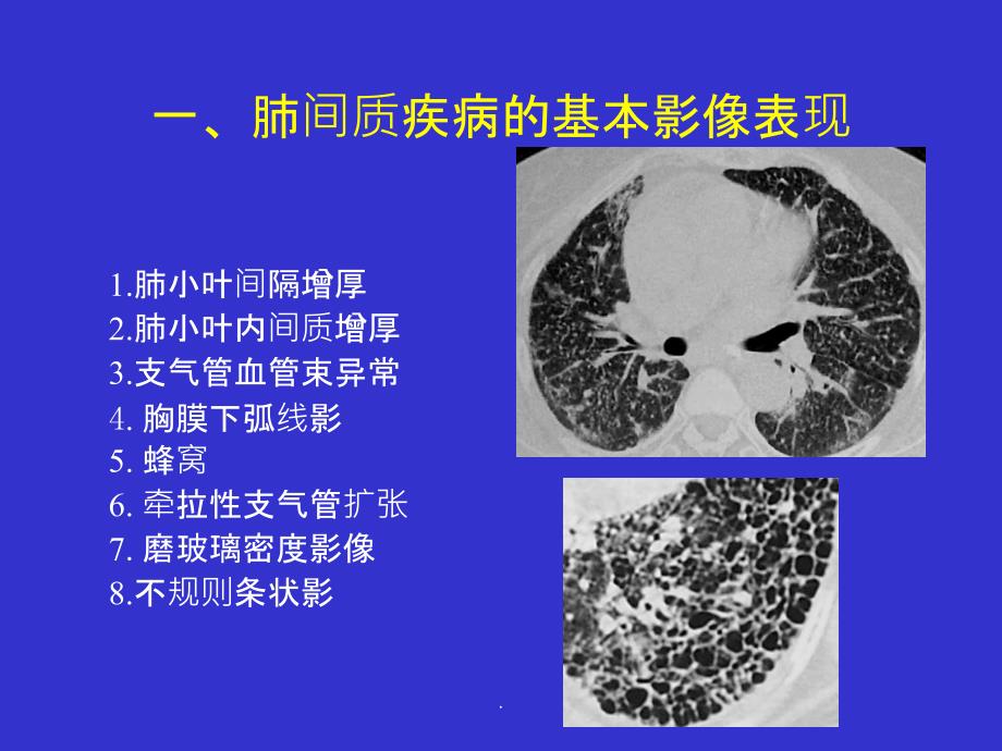 间质性肺疾病的CT诊断ppt课件_第2页