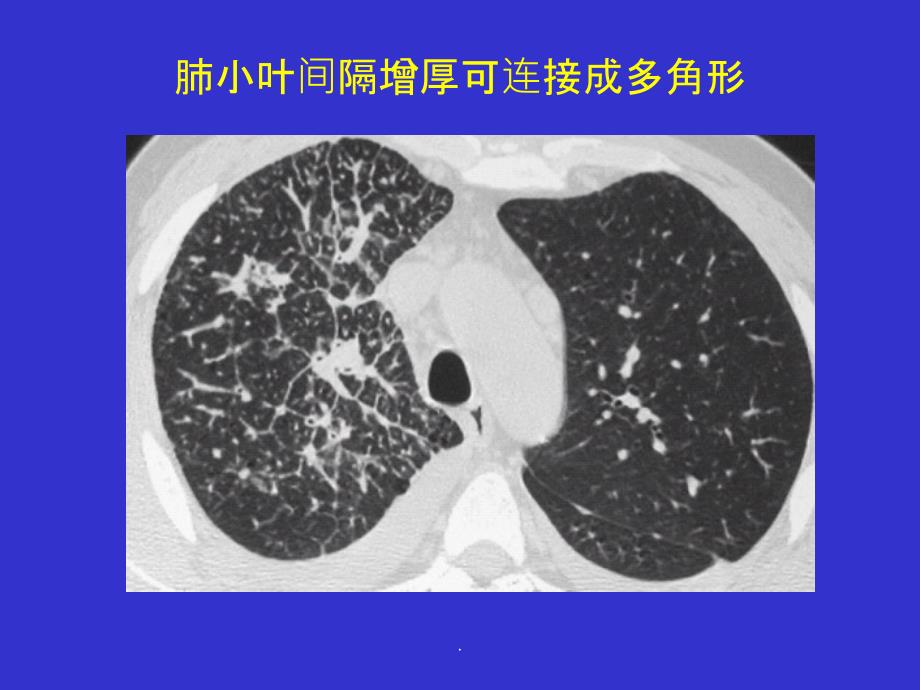 间质性肺疾病的CT诊断ppt课件_第4页