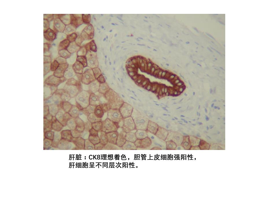 免疫组化结果判断及常见问题的分析（5.4）_第3页