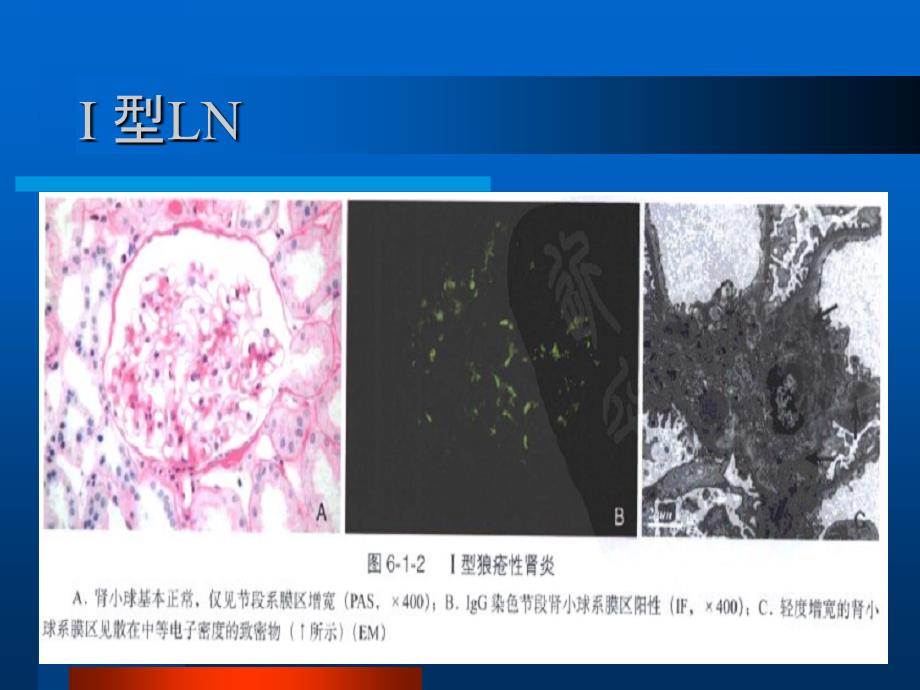 狼疮性肾炎病理分型及治疗(课堂PPT)_第3页