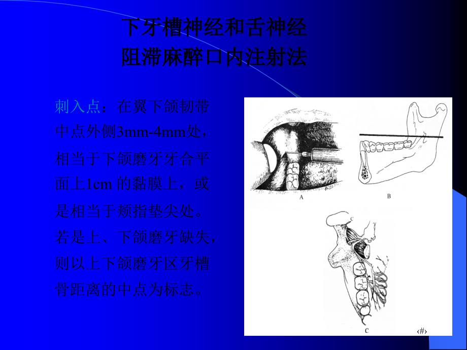 下颌局部麻醉_第4页