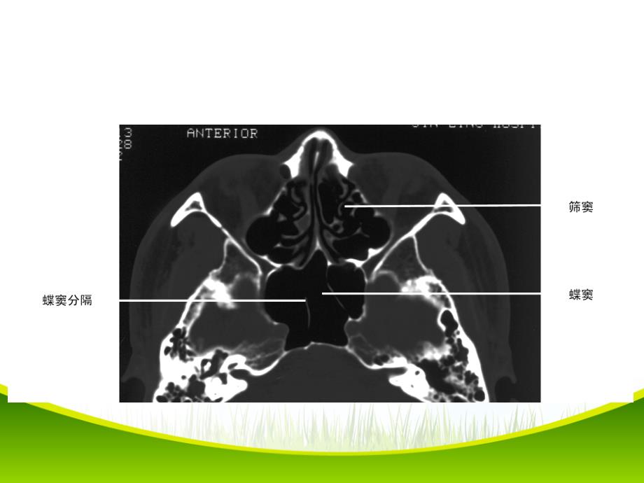 鼻和鼻窦病变CT诊断(课堂PPT)_第3页