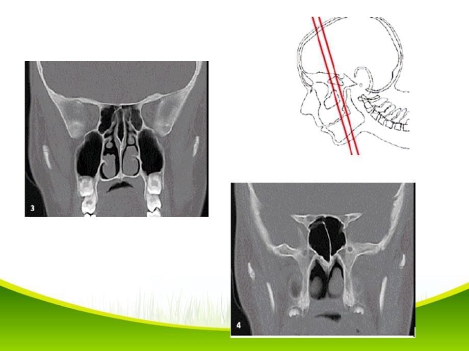 鼻和鼻窦病变CT诊断(课堂PPT)_第5页
