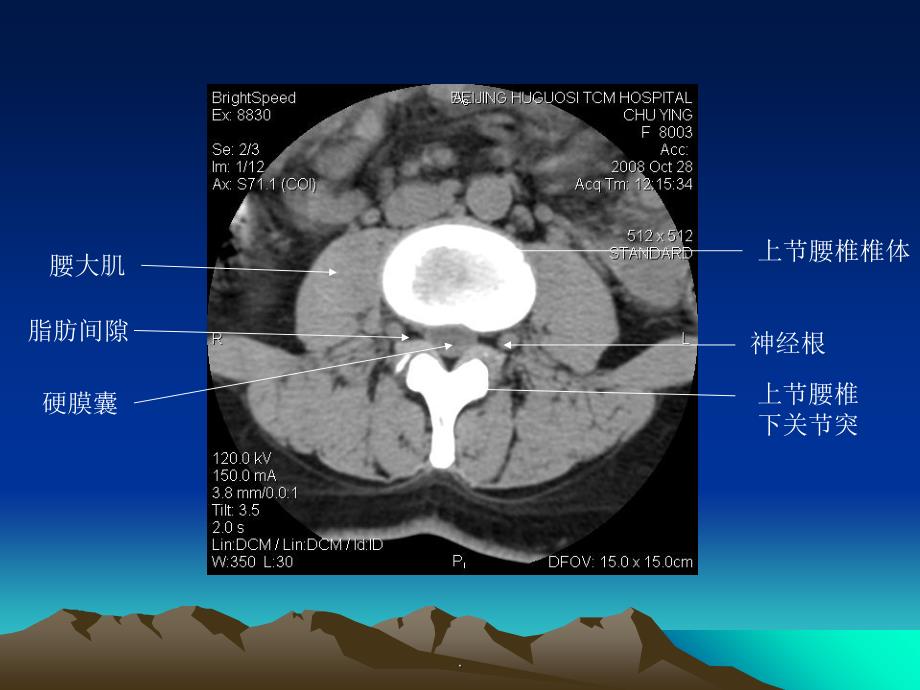 腰椎CT诊断大全-(新手实用)ppt课件_第3页