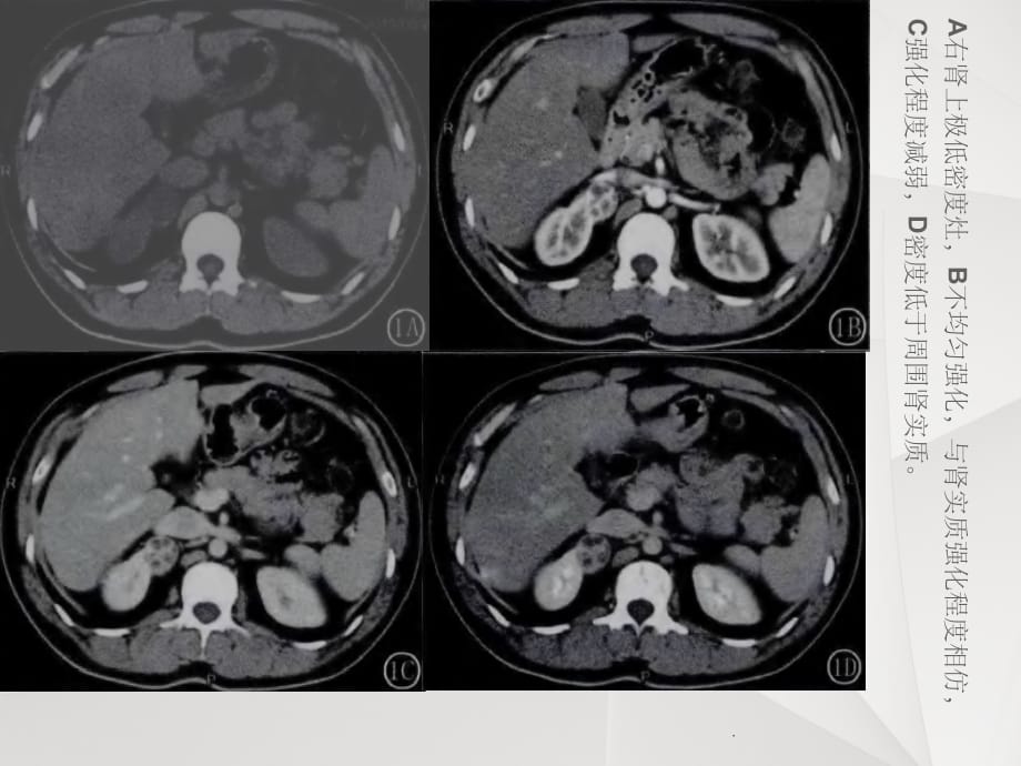 肾癌CT表现ppt课件_第5页