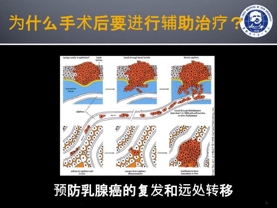 乳腺癌的综合治疗(课堂PPT)_第4页