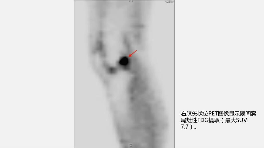 E之膝关节骨性关节炎影像学病例ppt课件_第3页