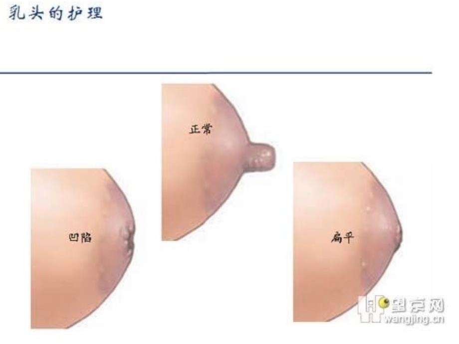 哺乳期乳房问题ppt课件_第4页