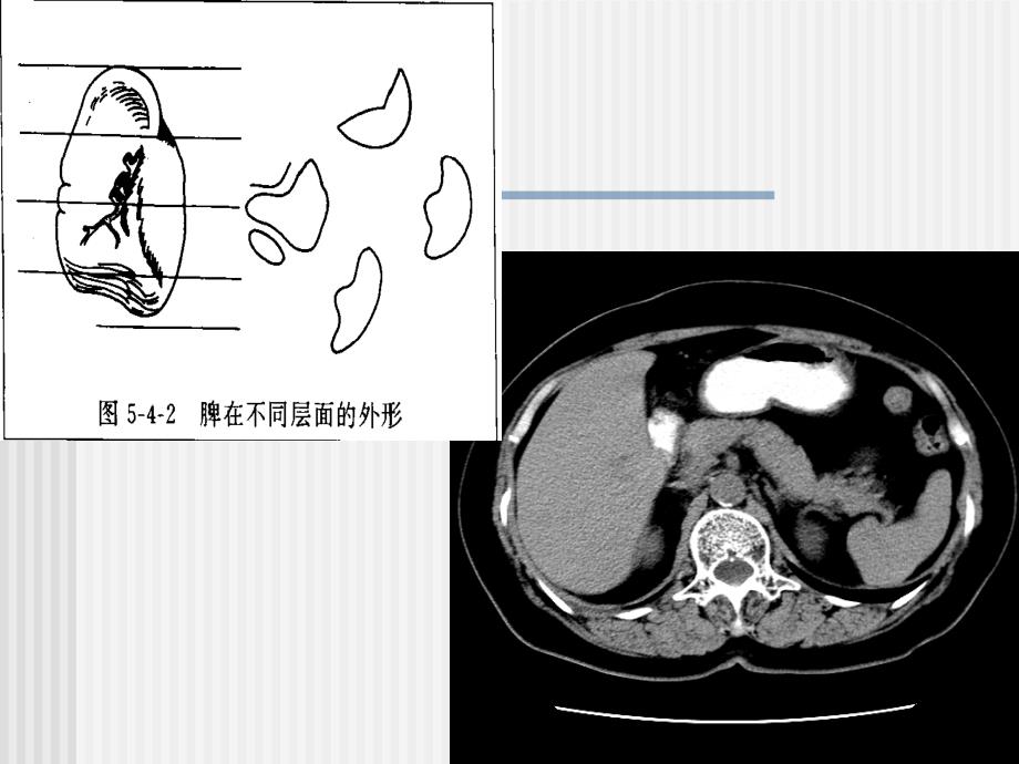 C脾脏及其疾病ppt课件_第4页