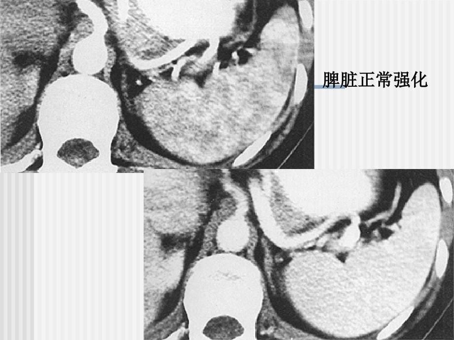 C脾脏及其疾病ppt课件_第5页