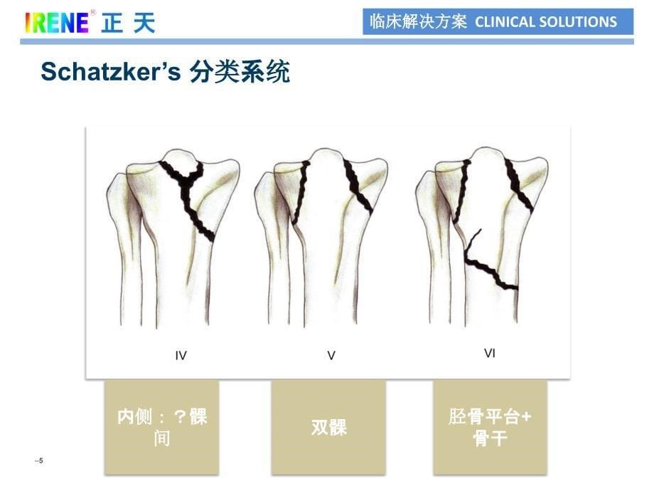 12-胫骨近段解决方案_第5页