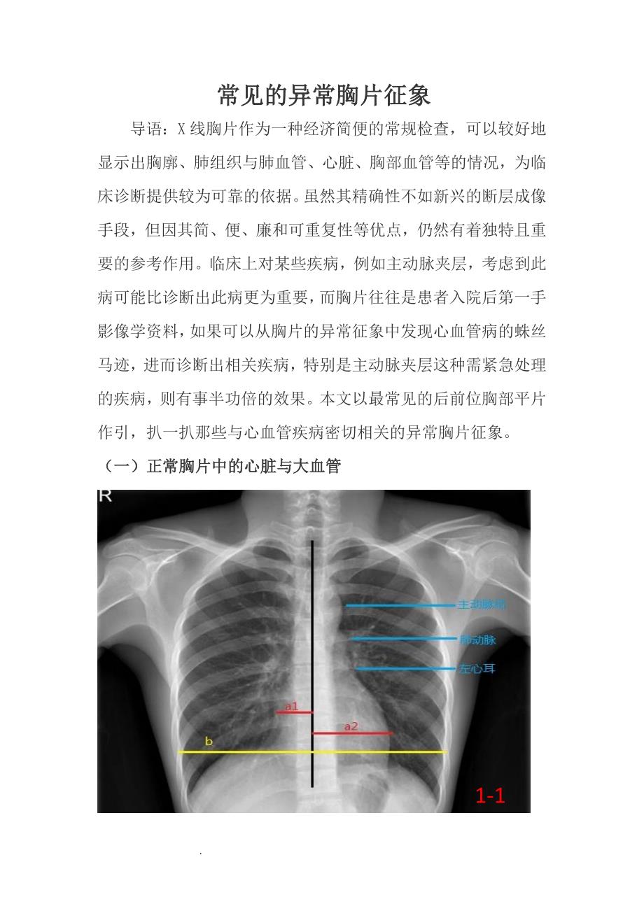 精选-常见的X线胸片_第1页