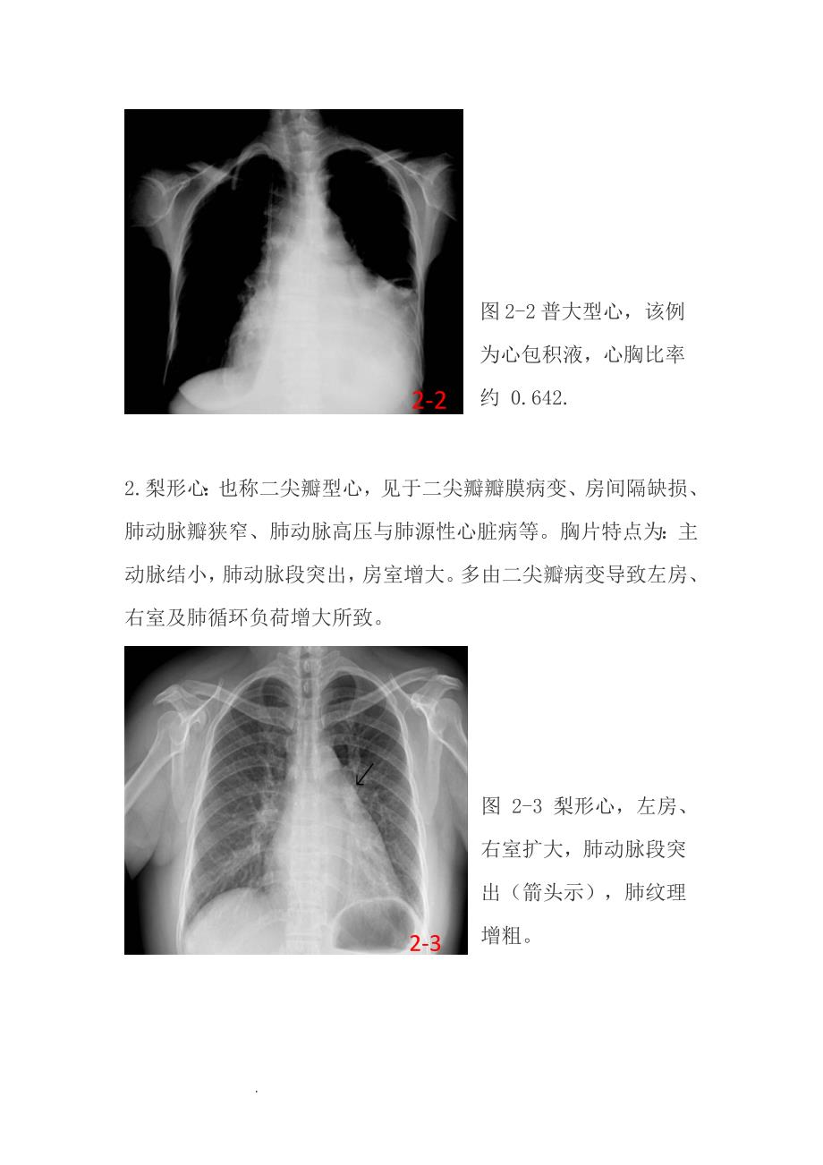 精选-常见的X线胸片_第3页