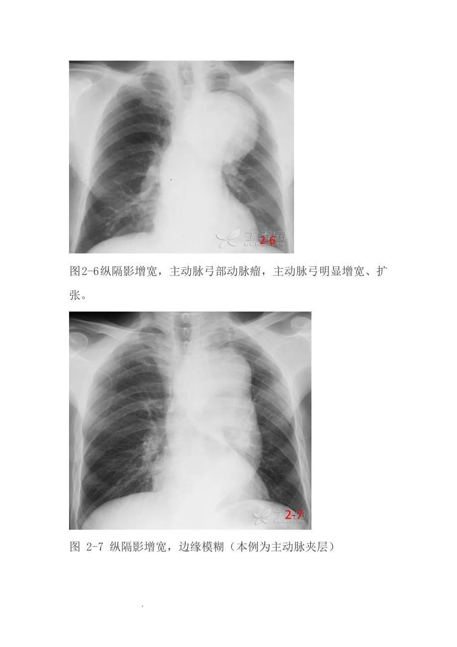 精选-常见的X线胸片_第5页