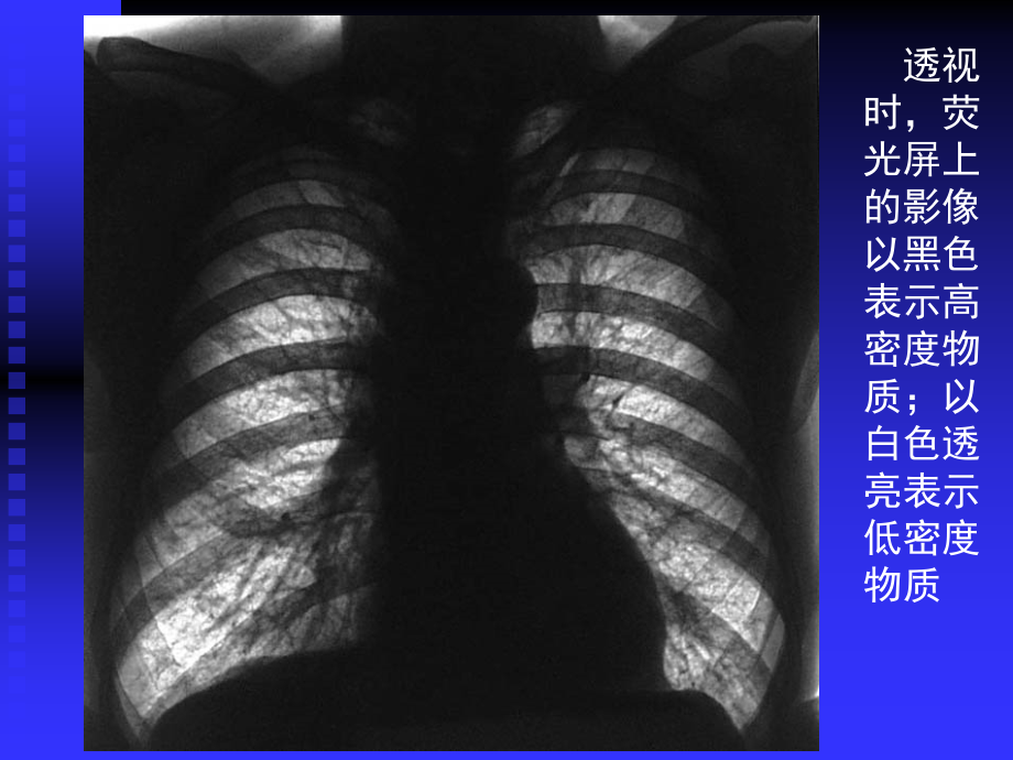 复旦肿瘤医院胸部影像学ppt课件_第3页
