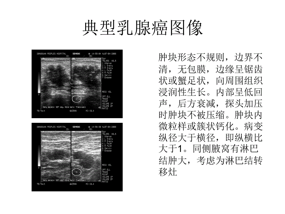 乳腺癌的声像图特点ppt课件_第3页