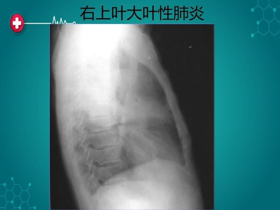 胸部常见疾病ppt课件_第5页