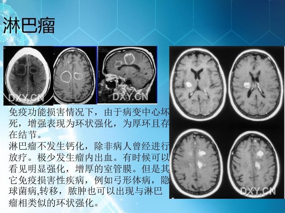 脑环形强化影像总结 修改版ppt课件_第5页