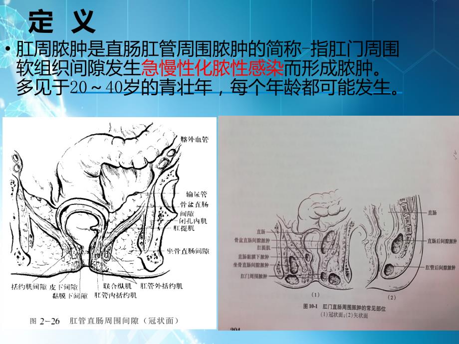 肛周脓肿课件ppt课件_第3页