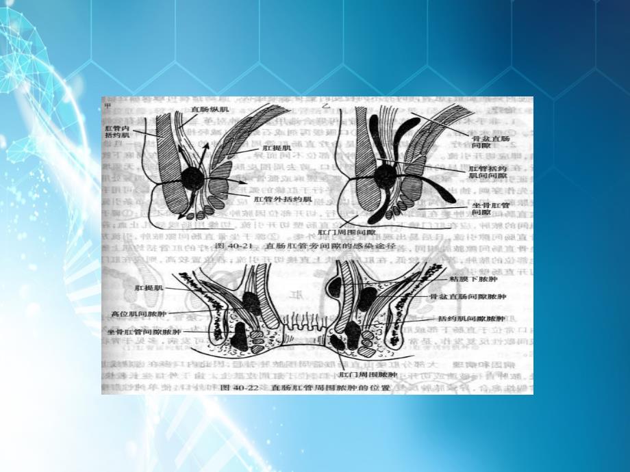 肛瘘课件ppt课件_第4页